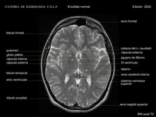 CATEDRA DE RADIOLOGIA U.N.L.P.   Encéfalo normal             Edición 2002



                                                   seno frontal


lóbulo frontal




                                                   cabeza del n. caudado
putamen
                                                   cápsula externa
globo pálido
cápsula interna                                    agujero de Monro
cápsula externa                                     III ventrículo

                                                    tálamo
lóbulo temporal                                    vena cerebral interna
atrio ventricular                                  cisterna vermiana
                                                   superior



 lóbulo occipital

                                                   seno sagital superior


                                                                  RM axial T2
 