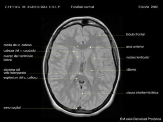 CATEDRA DE RADIOLOGIA U.N.L.P.   Encéfalo normal                Edición 2002




                                                        lóbulo frontal


rodilla del c. calloso                                 asta anterior
cabeza del n. caudado
cuerpo del ventrículo                                   núcleo lenticular
lateral


cisterna del                                            tálamo
velo interpuesto
esplenium del c. calloso



                                                        cisura interhemisférica



seno sagital


                                                    RM axial Densidad Protónica
 