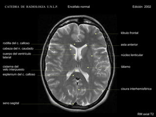 CATEDRA DE RADIOLOGIA U.N.L.P.   Encéfalo normal            Edición 2002




                                                    lóbulo frontal


rodilla del c. calloso                              asta anterior
cabeza del n. caudado
cuerpo del ventrículo                               núcleo lenticular
lateral


cisterna del                                        tálamo
velo interpuesto
esplenium del c. calloso



                                                    cisura interhemisférica



seno sagital


                                                                 RM axial T2
 