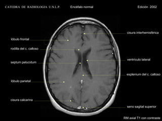 CATEDRA DE RADIOLOGIA U.N.L.P.   Encéfalo normal             Edición 2002




                                                     cisura interhemisférica

   lóbulo frontal


   rodilla del c. calloso


                                                     ventrículo lateral
   septum pelucidum


                                                     esplenium del c. calloso

   lóbulo parietal




   cisura calcarina

                                                     seno sagital superior


                                                   RM axial T1 con contraste
 