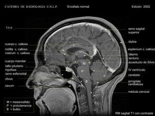 CATEDRA DE RADIOLOGIA U.N.L.P.   Encéfalo normal              Edición 2002




t.c.s.                                                      seno sagital
                                                            superior


                                                            diploe
cuerpo c. calloso
rodilla c. calloso                                          esplenium c. calloso
rostrum c. calloso                                          tálamo
                                                            tentorio
cuerpo mamilar                                              acueducto de Silvio
                                           M
tallo pituitario
hipófisis                                 P                 IV ventrículo
seno esfenoidal                                             cerebelo
clivus
                                               B            amígdala
cavum                                                       cerebelosa

                                                            médula cervical


 M = mesencéfalo
 P = protuberancia
 B = bulbo
                                                   RM sagital T1 con contraste
 