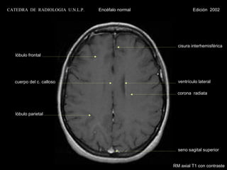 CATEDRA DE RADIOLOGIA U.N.L.P.   Encéfalo normal             Edición 2002




                                                     cisura interhemisférica

   lóbulo frontal




   cuerpo del c. calloso                             ventrículo lateral

                                                     corona radiata



   lóbulo parietal




                                                     seno sagital superior


                                                   RM axial T1 con contraste
 