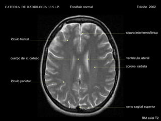 CATEDRA DE RADIOLOGIA U.N.L.P.   Encéfalo normal           Edición 2002




                                                   cisura interhemisférica

   lóbulo frontal




   cuerpo del c. calloso                           ventrículo lateral

                                                   corona radiata



   lóbulo parietal




                                                   seno sagital superior


                                                               RM axial T2
 