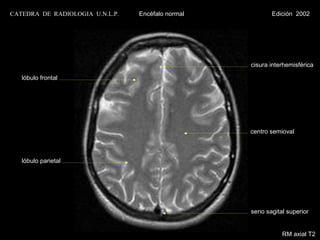 CATEDRA DE RADIOLOGIA U.N.L.P.   Encéfalo normal          Edición 2002




                                                   cisura interhemisférica

   lóbulo frontal




                                                   centro semioval



   lóbulo parietal




                                                   seno sagital superior


                                                              RM axial T2
 
