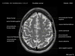 CATEDRA DE RADIOLOGIA U.N.L.P.   Encéfalo normal           Edición 2002




     lóbulo frontal                                circunvolución frontal
                                                   superior
     surco frontal superior

                                                   cisura interhemisférica
     circunvolución
     frontal media
                                                   centro semioval


                                                   circunvolución
     cisura de Rolando                             precentral (motora)
     circunvolución
     postcentral                                   cisura calcarina



                                                   seno sagital superior



                                                              RM axial T2
 