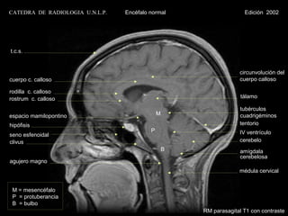 CATEDRA DE RADIOLOGIA U.N.L.P.   Encéfalo normal                     Edición 2002




t.c.s.


                                                                   circunvolución del
cuerpo c. calloso                                                  cuerpo calloso

rodilla c. calloso
rostrum c. calloso                                                  tálamo

                                                                   tubérculos
espacio mamilopontino                         M                    cuadrigéminos
hipófisis                                                          tentorio
                                          P                        IV ventrículo
seno esfenoidal
clivus                                                             cerebelo
                                                  B                amígdala
                                                                   cerebelosa
agujero magno
                                                                   médula cervical


 M = mesencéfalo
 P = protuberancia
 B = bulbo
                                                      RM parasagital T1 con contraste
 