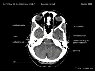 CATEDRA DE RADIOLOGIA U.N.L.P.   Encéfalo normal              Edición 2002




        celdilla etmoidal
                                                   nervio óptico




         clivus                                    lóbulo temporal

                                                   cisterna del ángulo
        protuberancia                              pontocerebeloso



                                                   cerebelo




         t.c.s.


                                                     TC axial con contraste
 