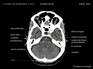 CATEDRA DE RADIOLOGIA U.N.L.P.   Encéfalo normal              Edición 2002




       seno esfenoidal
                                                   lóbulo temporal
       dorso selar
       a. basilar                                  cisterna prepontina

       protuberancia                               cisterna del ángulo
                                                   pontocerebeloso

                                                   IV ventrículo
       vermis cerebeloso
                                                   cerebelo



       t.c.s.


                                                     TC axial con contraste
 