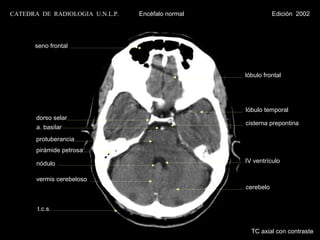 CATEDRA DE RADIOLOGIA U.N.L.P.   Encéfalo normal              Edición 2002




      seno frontal



                                                   lóbulo frontal




                                                   lóbulo temporal
       dorso selar
                                                   cisterna prepontina
       a. basilar
       protuberancia
       pirámide petrosa

       nódulo                                      IV ventrículo

       vermis cerebeloso
                                                   cerebelo


       t.c.s.


                                                     TC axial con contraste
 