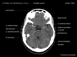 CATEDRA DE RADIOLOGIA U.N.L.P.   Encéfalo normal                Edición 2002



   seno frontal




                                                   lóbulo frontal


                                                   a. cerebral anterior
   a. cerebral media
                                                   cisterna supraselar
   asta temporal
                                                   a. basilar
   a. cerebral posterior
                                                   protuberancia


   IV ventrículo

                                                   vermis cerebeloso

                                                   cerebelo




                                                       TC axial con contraste
 