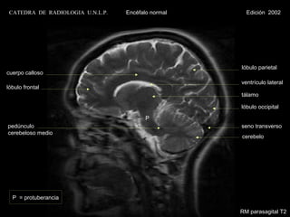 CATEDRA DE RADIOLOGIA U.N.L.P.   Encéfalo normal     Edición 2002




                                                    lóbulo parietal
cuerpo calloso
                                                    ventrículo lateral
lóbulo frontal
                                                    tálamo

                                                    lóbulo occipital

                                         P
pedúnculo                                           seno transverso
cerebeloso medio
                                                    cerebelo




  P = protuberancia

                                                    RM parasagital T2
 