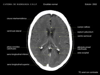 CATEDRA DE RADIOLOGIA U.N.L.P.   Encéfalo normal            Edición 2002




   cisura interhemisférica



                                                   cuerpo calloso

   ventrículo lateral                              septum pelucidum

                                                   centro semioval




   plexo coroideo                                  glándula pineal
   calcificado                                     calcificada
                                                   asta occipital
   seno longitudinal inferior




   seno longitudinal superior



                                                    TC axial con contraste
 