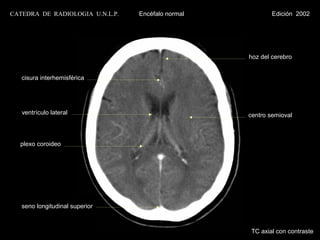 CATEDRA DE RADIOLOGIA U.N.L.P.   Encéfalo normal           Edición 2002




                                                   hoz del cerebro


   cisura interhemisférica




   ventrículo lateral                              centro semioval



  plexo coroideo




   seno longitudinal superior



                                                    TC axial con contraste
 