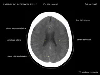 CATEDRA DE RADIOLOGIA U.N.L.P.   Encéfalo normal            Edición 2002




                                                   hoz del cerebro



  cisura interhemisférica




   ventrículo lateral                              centro semioval




   cisura interhemisférica




                                                     TC axial con contraste
 
