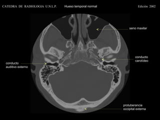 CATEDRA DE RADIOLOGIA U.N.L.P.   Hueso temporal normal              Edición 2002




                                                             seno maxilar




                                                                  conducto
                                                                  carotídeo
 conducto
 auditivo externo




                                                         protuberancia
                                                         occipital externa
 