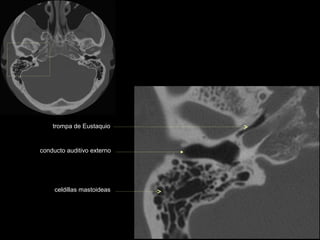 trompa de Eustaquio


conducto auditivo externo




     celdillas mastoideas
 