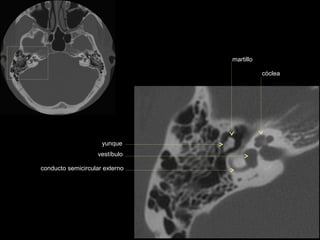 martillo

                                           cóclea




                     yunque
                    vestíbulo

conducto semicircular externo
 