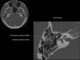 nervio facial




articulación yunque/martillo

  conducto auditivo interno
 