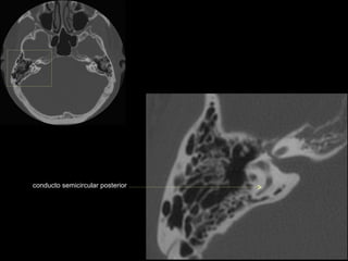 conducto semicircular posterior
 