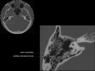 antro mastoideo

celdillas retrolaberínticas
 