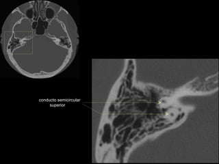 conducto semicircular
     superior
 