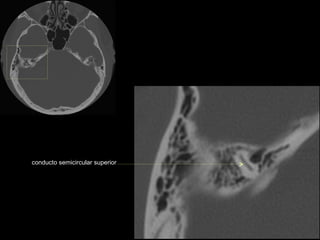 conducto semicircular superior
 