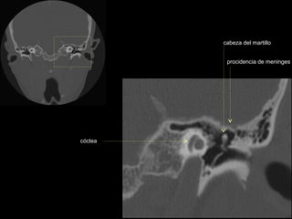 cabeza del martillo


          procidencia de meninges




cóclea
 