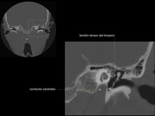 tendón tensor del tímpano




conducto carotídeo
 