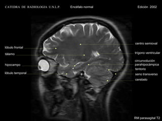 CATEDRA DE RADIOLOGIA U.N.L.P.   Encéfalo normal     Edición 2002




                                                   centro semioval
lóbulo frontal

tálamo                                             trígono ventricular

                                                   circunvolución
hipocampo                                          parahipocámpica
                                                   tentorio
lóbulo temporal                                    seno transverso
                                                   cerebelo




                                                   RM parasagital T2
 