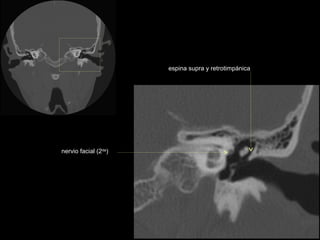 espina supra y retrotimpánica




nervio facial (2da)
 