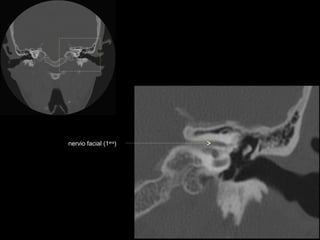 nervio facial (1era)
 