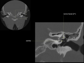 nervio facial (2da)




estribo
 
