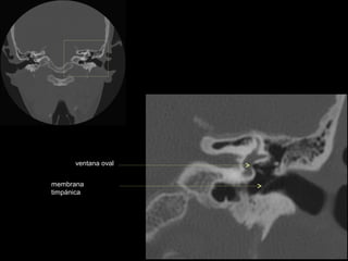 ventana oval


membrana
timpánica
 