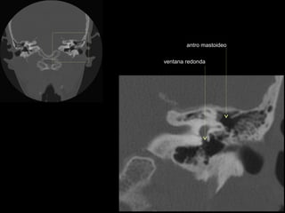antro mastoideo

ventana redonda
 