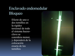 Enclavado endomedular 
Bloqueo 
Efecto de uno o 
dos tornillos en 
la rigidez 
torsional de todo 
el sistema hueso-clavo 
se 
considera menor, 
y dependerá de la 
colocación 
exacta de los 
tornillos 
 