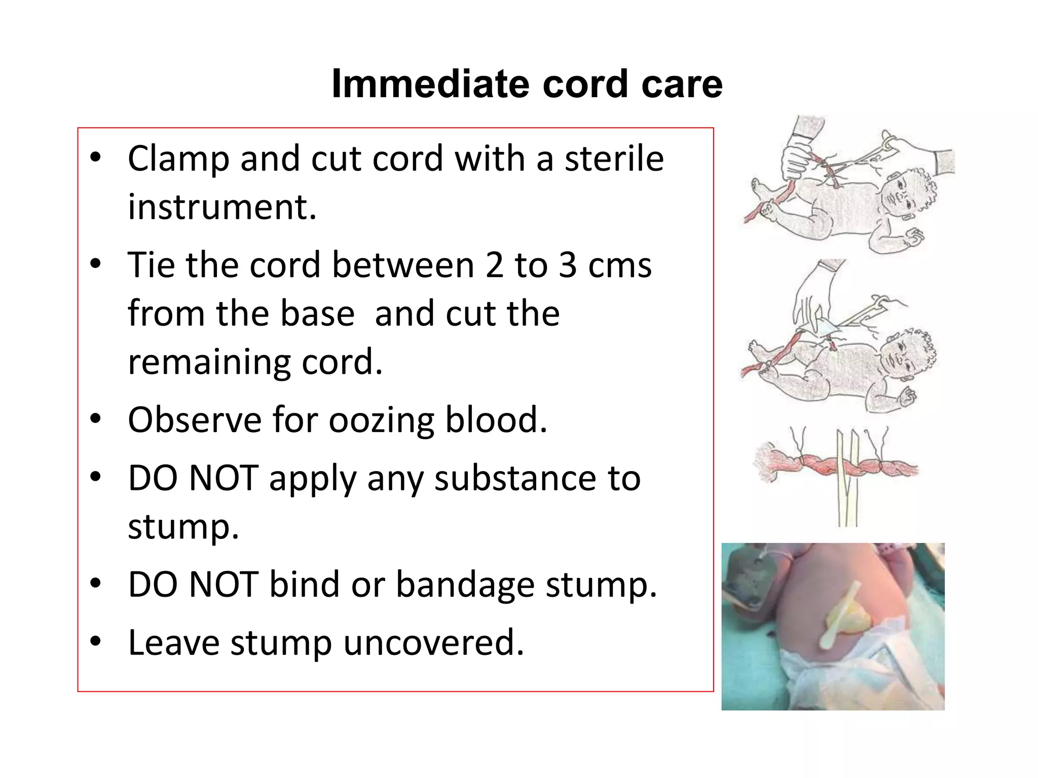 Immediate cord care
• Clamp and cut cord with a sterile
instrument.
• Tie the cord between 2 to 3 cms
from the base and cut the
remaining cord.
• Observe for oozing blood.
• DO NOT apply any substance to
stump.
• DO NOT bind or bandage stump.
• Leave stump uncovered.
 