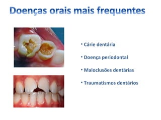 • Cárie dentária

• Doença periodontal

• Maloclusões dentárias

• Traumatismos dentários
 