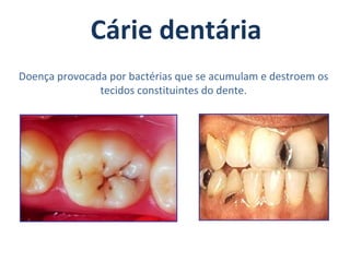 Cárie dentária
Doença provocada por bactérias que se acumulam e destroem os
               tecidos constituintes do dente.
 