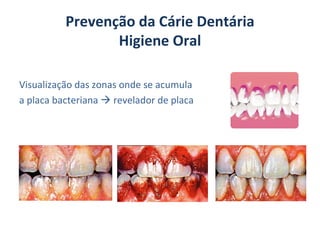 Prevenção da Cárie Dentária
                 Higiene Oral

Visualização das zonas onde se acumula
a placa bacteriana  revelador de placa
 