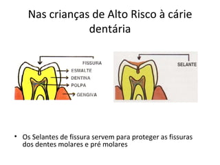 Nas crianças de Alto Risco à cárie
                dentária




• Os Selantes de fissura servem para proteger as fissuras
  dos dentes molares e pré molares
 