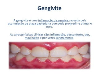 Gengivite
   A gengivite é uma inflamação da gengiva causada pela
acumulação de placa bacteriana que pode progredir e atingir o
                           osso.

 As características clínicas são: inflamação, desconforto, dor,
            mau hálito e por vezes sangramento.
 