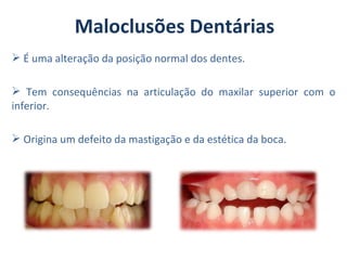 Maloclusões Dentárias
 É uma alteração da posição normal dos dentes.

 Tem consequências na articulação do maxilar superior com o
inferior.

 Origina um defeito da mastigação e da estética da boca.
 