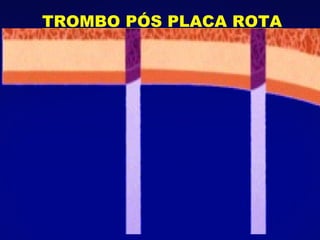 TROMBO PÓS PLACA ROTA 