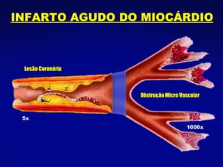 INFARTO AGUDO DO MIOCÁRDIO Lesão Coronária Obstrução Micro Vascular 5x 1000x 