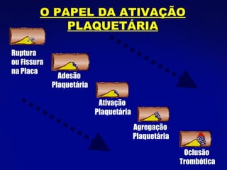 Ruptura ou Fissura na Placa O PAPEL DA ATIVAÇÃO PLAQUETÁRIA Agregação  Plaquetária Ativação  Plaquetária Adesão  Plaquetária Oclusão Trombótica 
