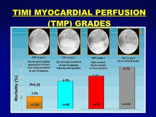 TIMI MYOCARDIAL PERFUSION (TMP) GRADES 