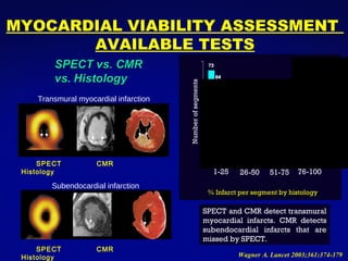 Wagner A. Lancet 2003;361:374-379 1-25 26-50 51-75 76-100 % Infarct per segment by histology Number of segments SPECT  CMR  Histology SPECT  CMR  Histology Subendocardial infarction Transmural myocardial infarction SPECT and CMR detect transmural myocardial infarcts. CMR detects subendocardial infarcts that are missed by SPECT. MYOCARDIAL VIABILITY ASSESSMENT  AVAILABLE TESTS 