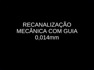 RECANALIZAÇÃO MECÂNICA COM GUIA 0,014mm 
