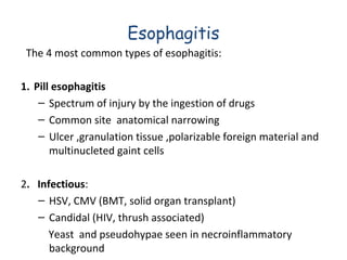 Esophagitis
The 4 most common types of esophagitis:
1. Pill esophagitis
– Spectrum of injury by the ingestion of drugs
– Common site anatomical narrowing
– Ulcer ,granulation tissue ,polarizable foreign material and
multinucleted gaint cells
2. Infectious:
– HSV, CMV (BMT, solid organ transplant)
– Candidal (HIV, thrush associated)
Yeast and pseudohypae seen in necroinflammatory
background

 
