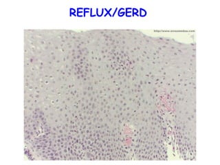 REFLUX/GERD

 